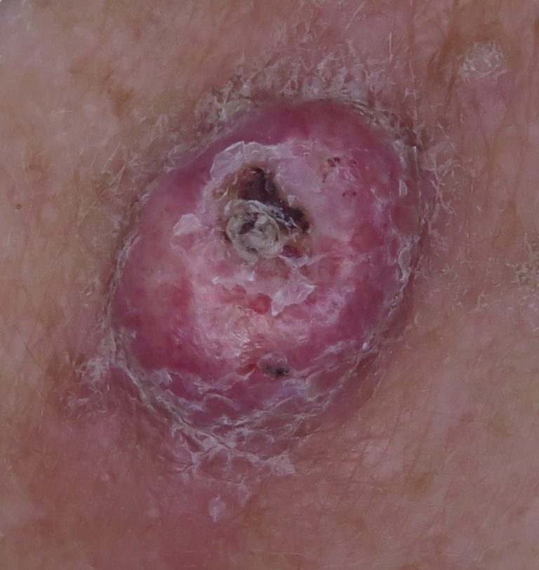 Summerland Skin Cancer Clinic » Squamous Cell Carcinoma