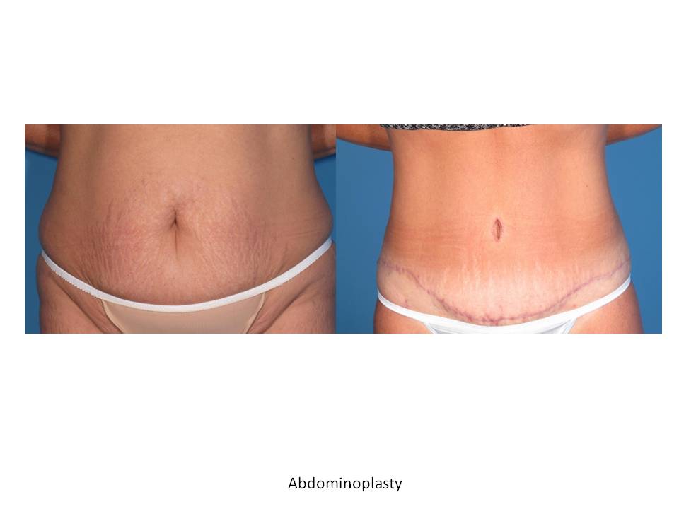 Abdominoplasty Tummy Tuck Surgery Wilmington & Supply, NC