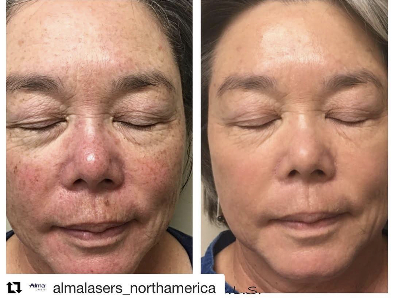 ClearLift™ Skin Rejuvenation Lunch Time Facelift Summit Medical Spa