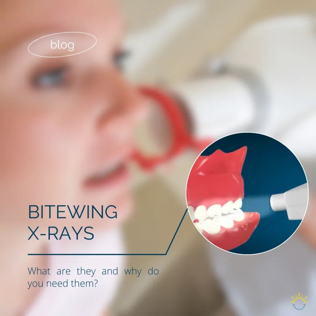 Bitewing Xrays What are they and why do you need them?