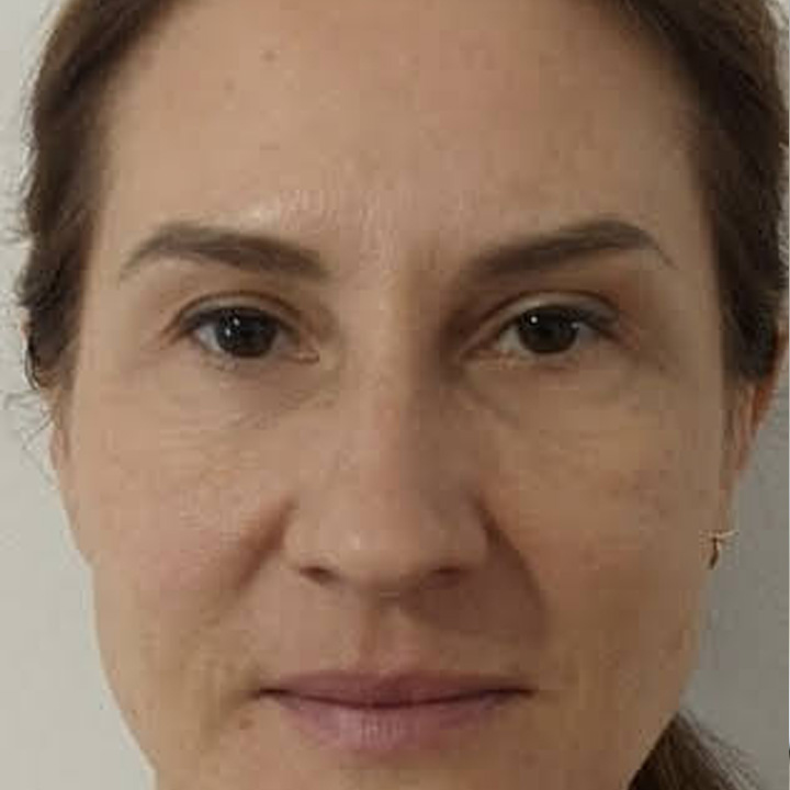 Botox Injections New Jersey Sunny Aesthetic