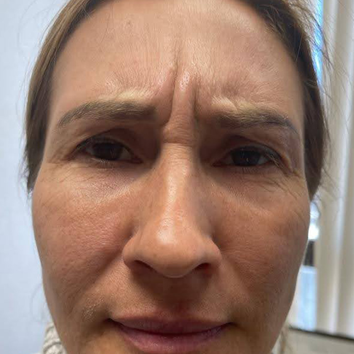 Botox Injections New Jersey Sunny Aesthetic