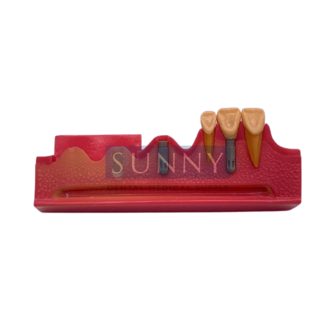 Tooth Study Model Implant Stages Sunny Dental Medical Supply