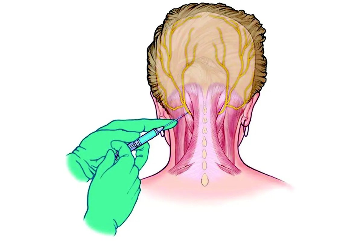 What is Occipital Nerve Block? Sun Pain Management