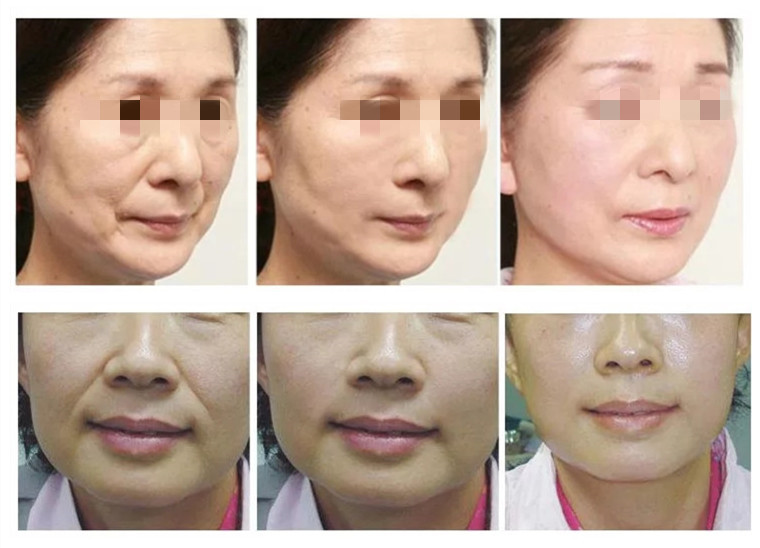 Thermolift face lift wrinkle removal anti aging skin rejuvenation