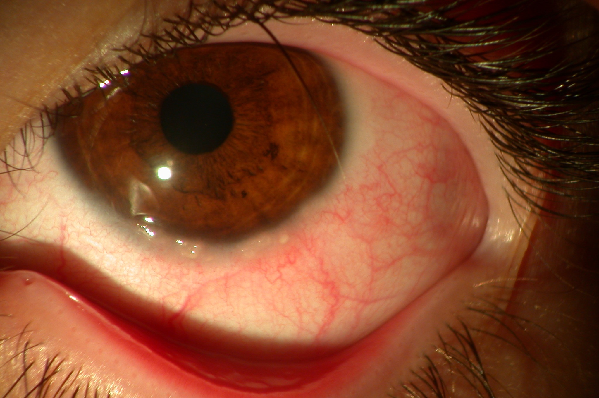 Vernal keratoconjunctivitis (VKC)