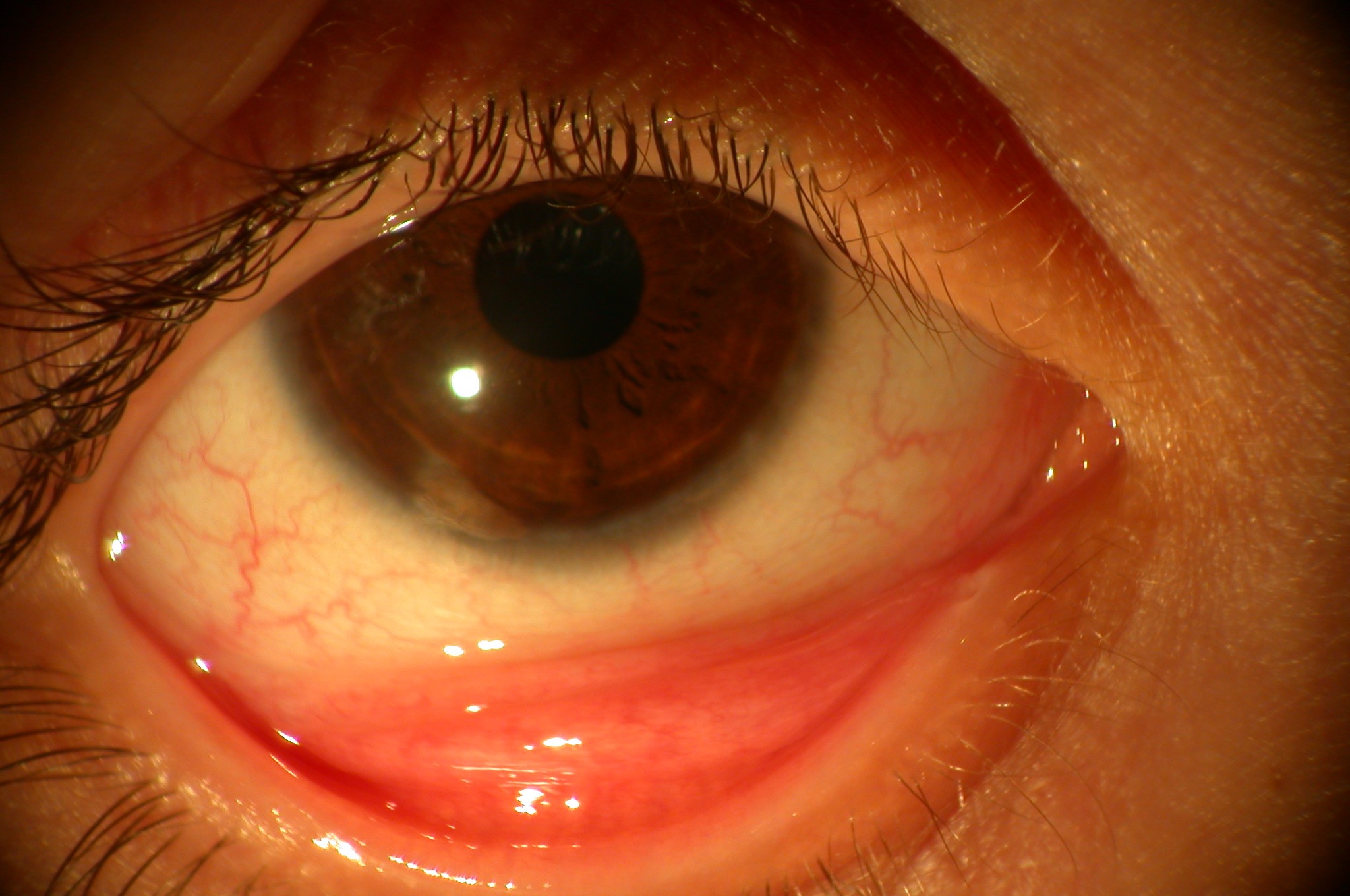 Vernal keratoconjunctivitis (VKC)