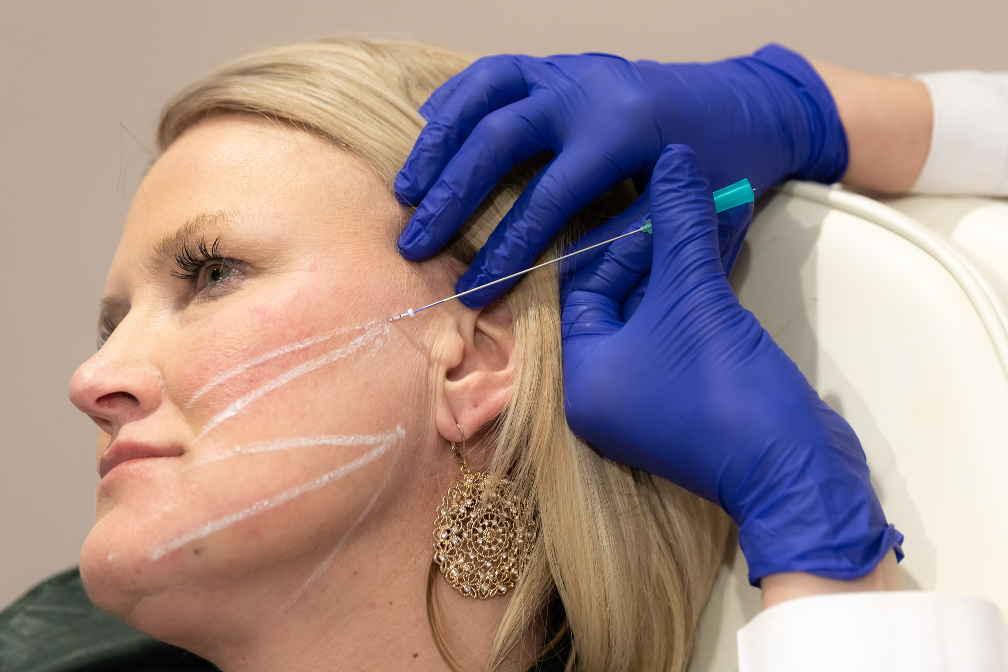 NonSurgical Facelift in Marquette Superior Aesthetics