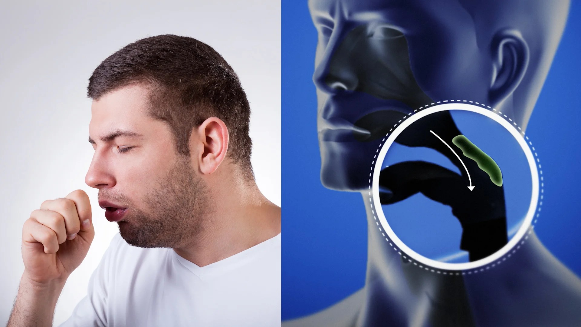 What are the Symptoms of Wet Cough and the Treatment for Wet Cough