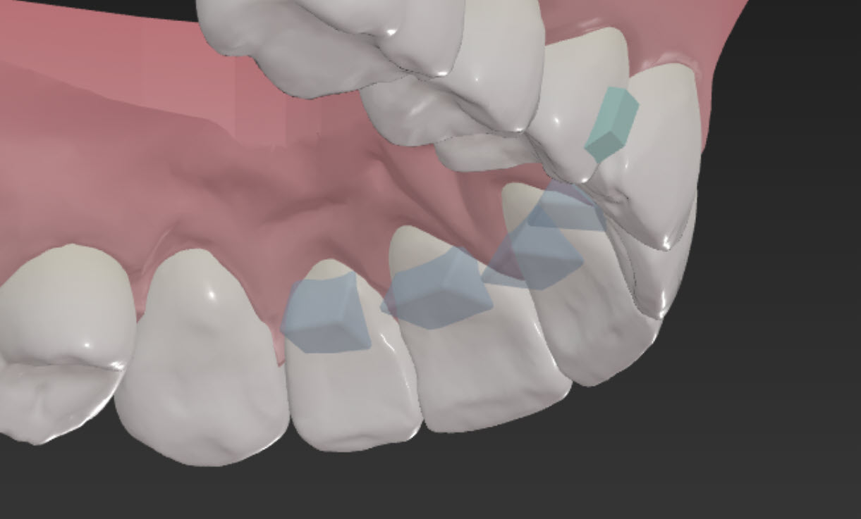 Bite Ramps ClearCorrect Support