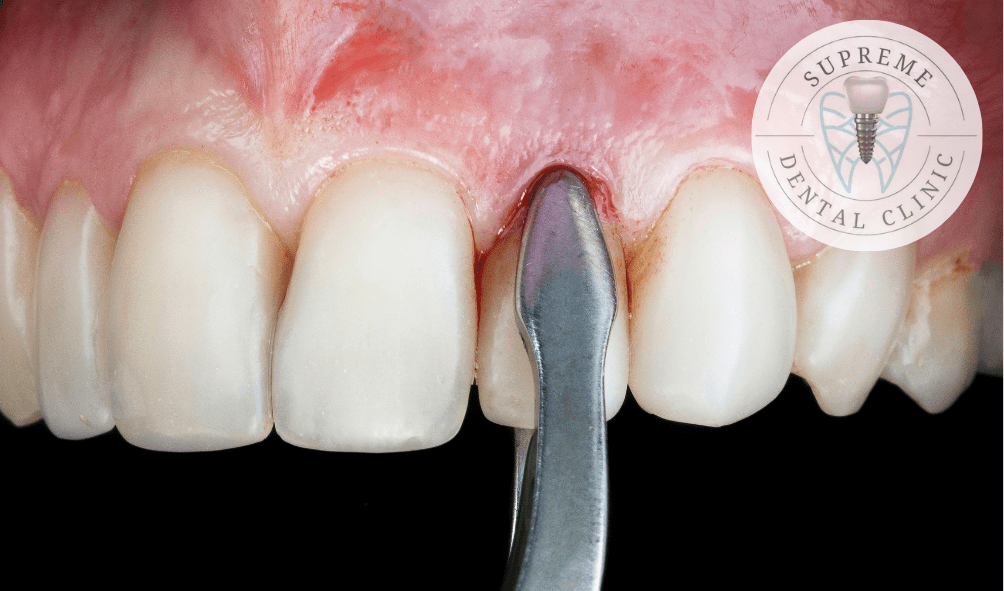 Tooth Extraction in Stamford How much is Tooth Extraction?