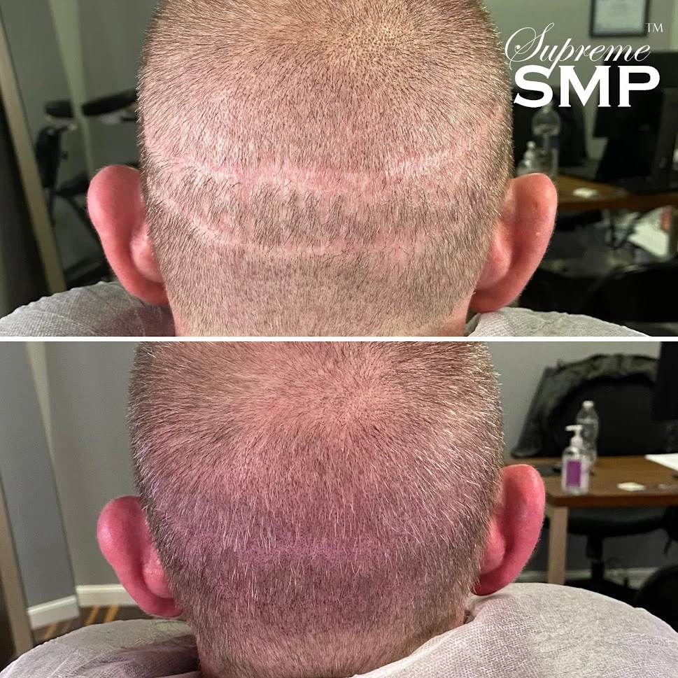 Scalp Scar Treatment Massachusetts, USA Supreme SMP
