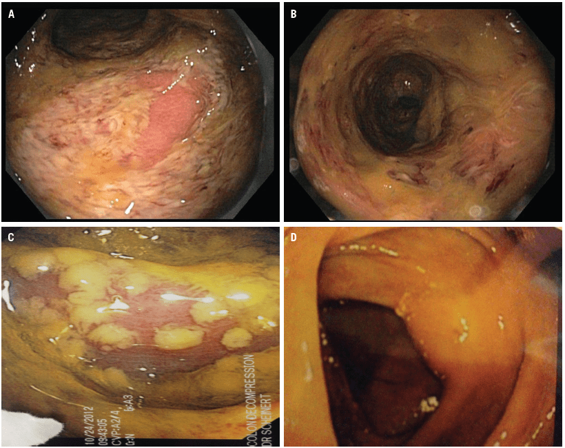 Treatment For C Diff