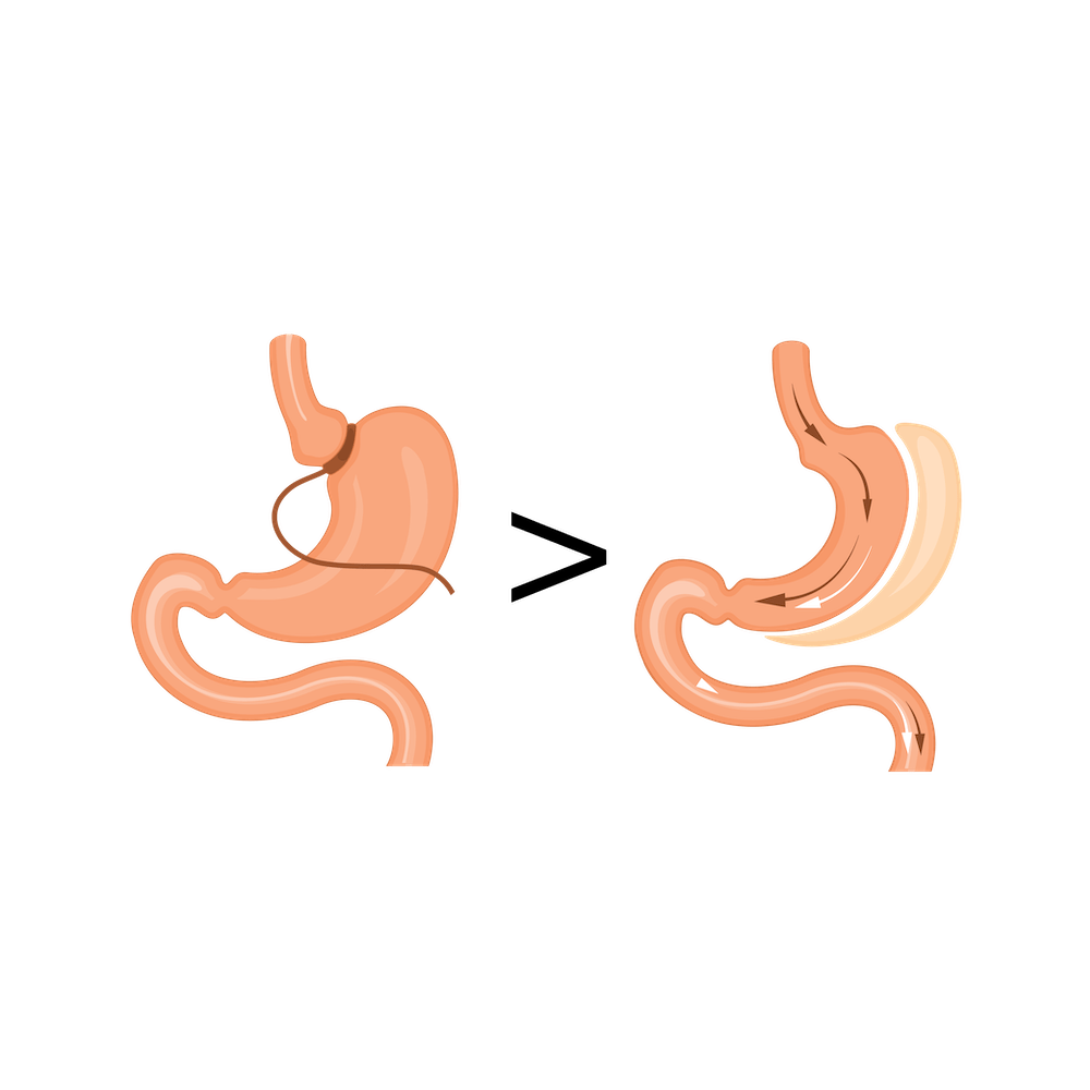 Bariatric Revision Surgery Advisors