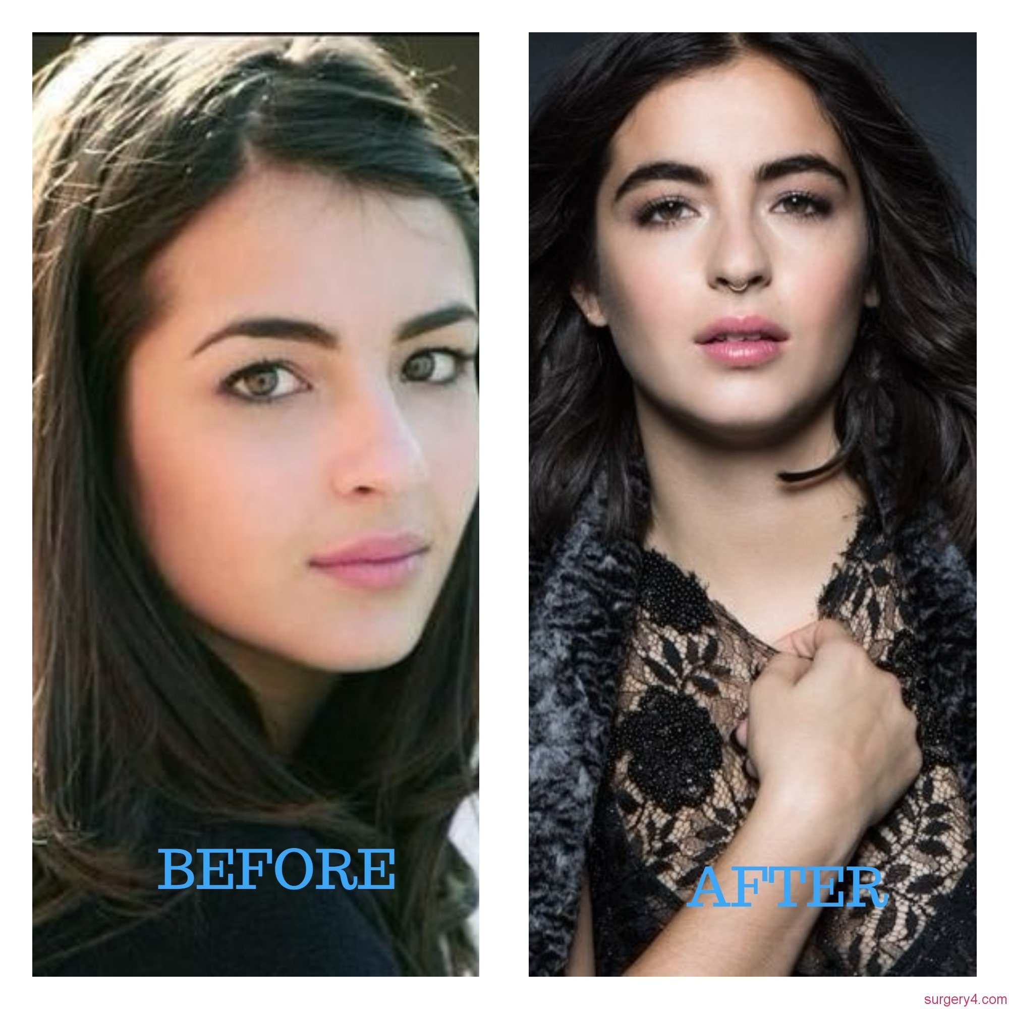Alanna Masterson Botox Photos [Before & After] Surgery4