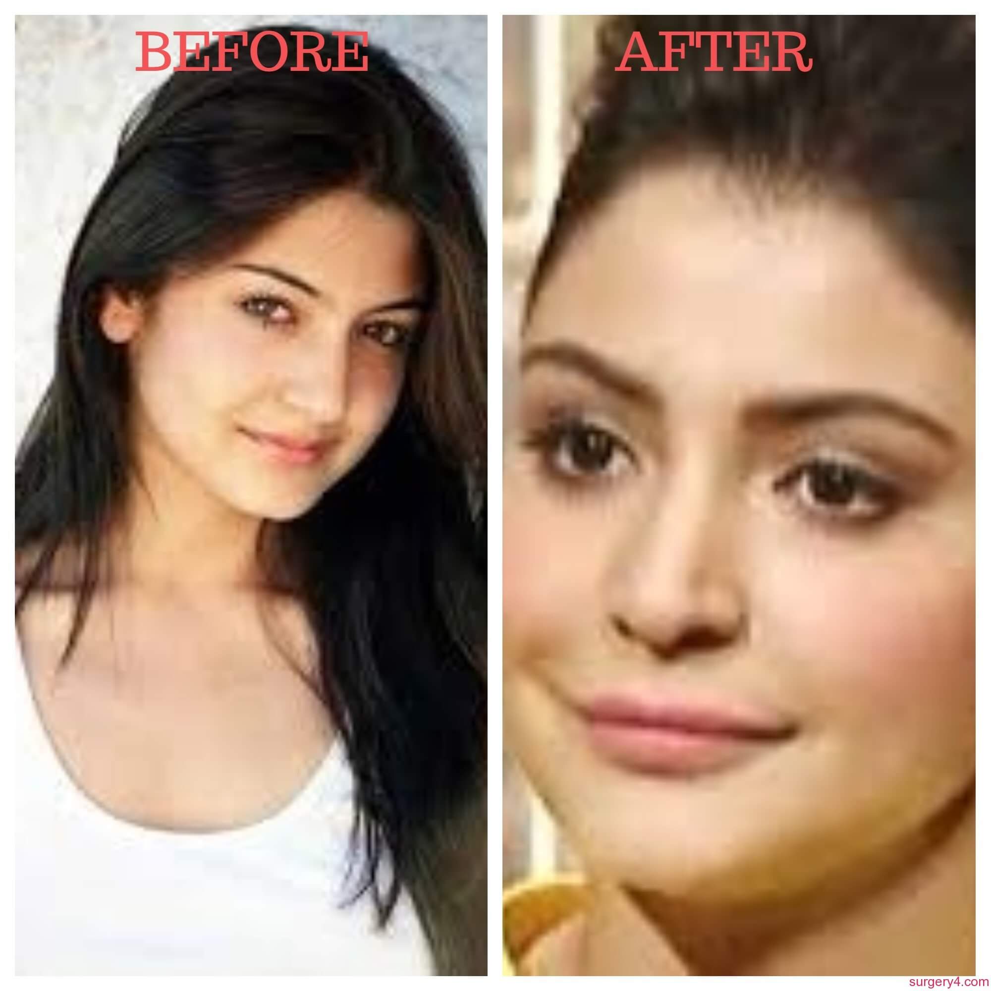 Anushka Sharma Lip Job Photos [Before & After] Surgery4
