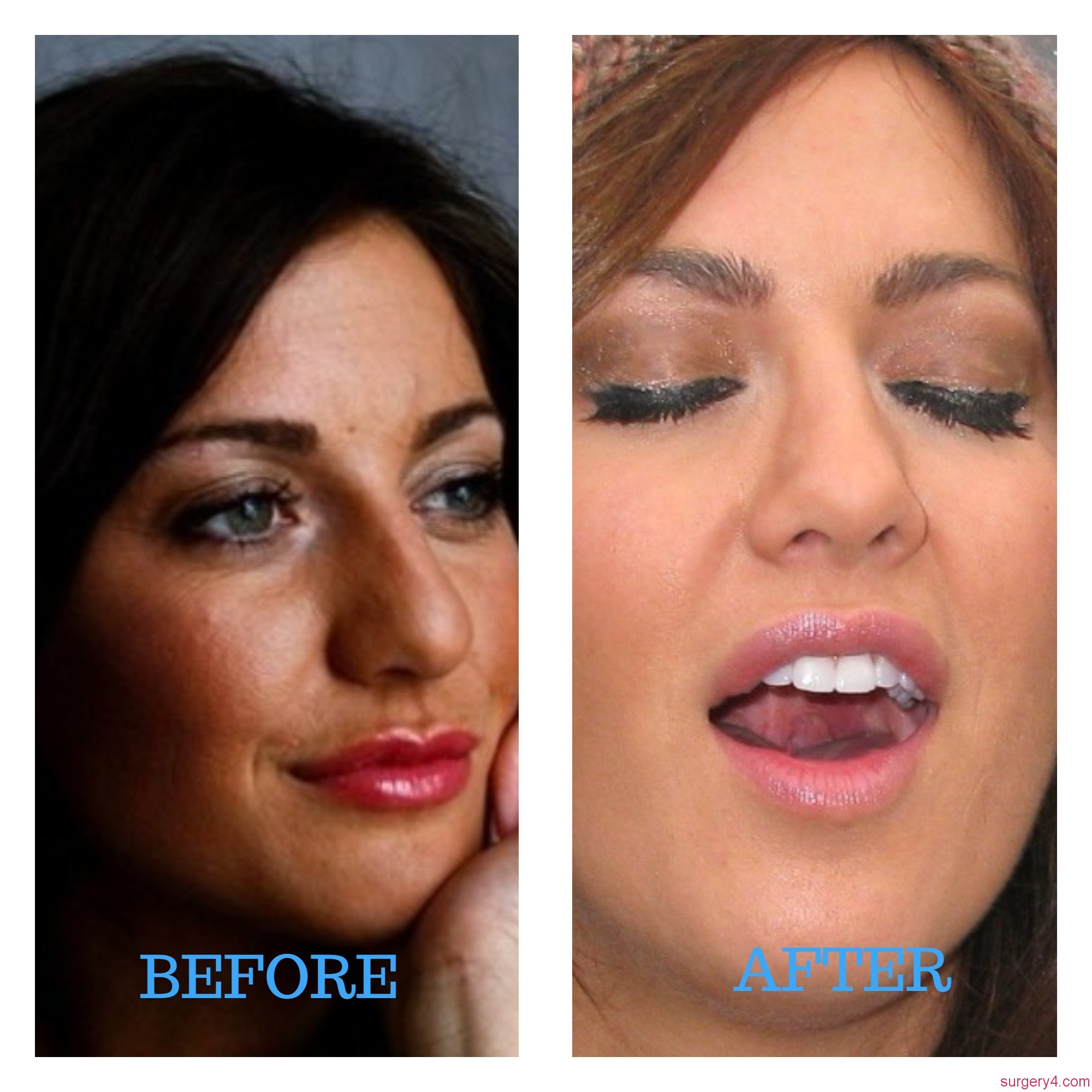 Jillian Harris Nose Job Photos [Before & After] - Surgery4