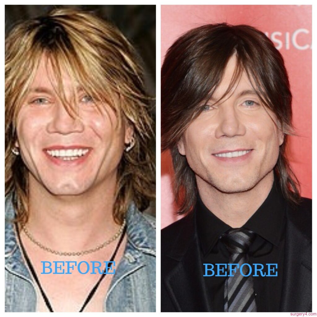John Rzeznik Plastic Surgery Photos [Before & After] ⋆ Surgery4