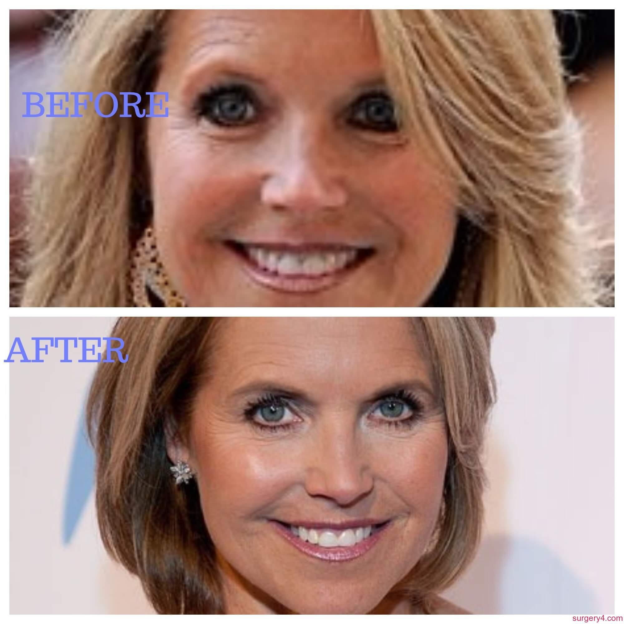Katie Couric Plastic Surgery Photos [Before & After] - Surgery4