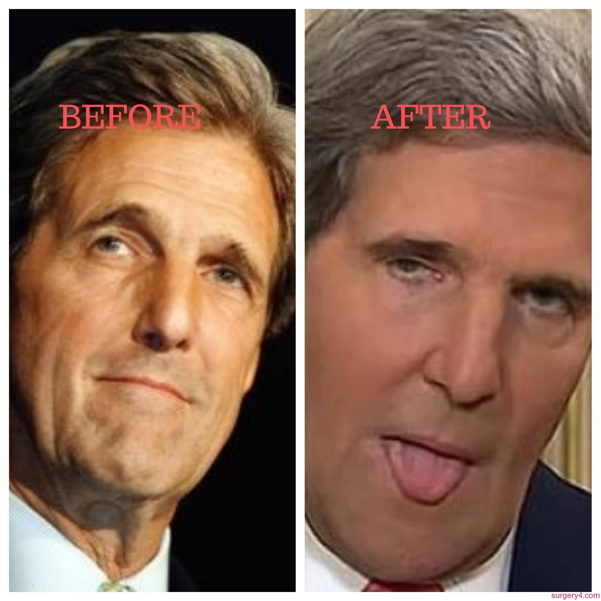 John Kerry Facelift Photos [Before & After] ⋆ Surgery4