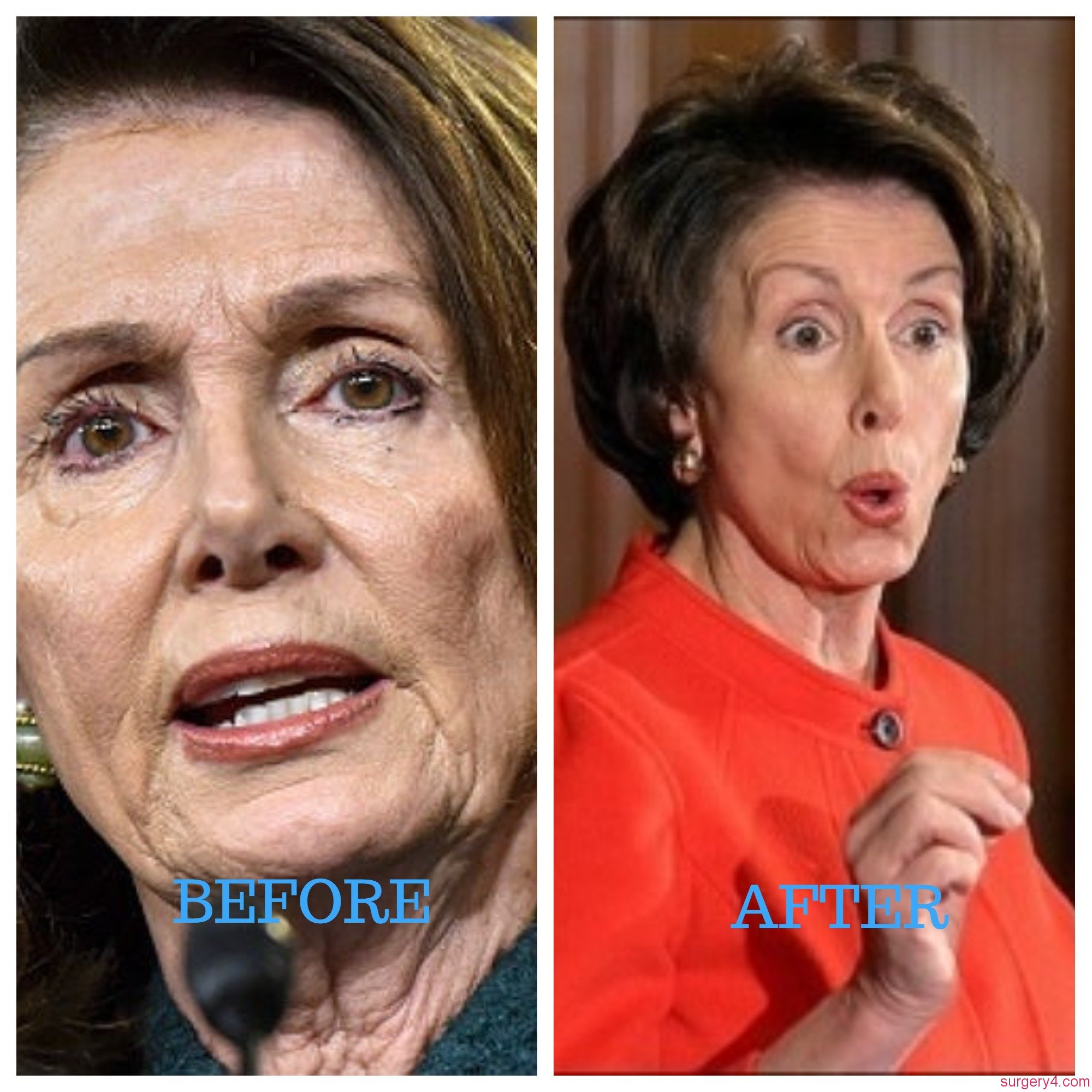 Sandie Rinaldo Plastic Surgery Photos [Before & After] Surgery4