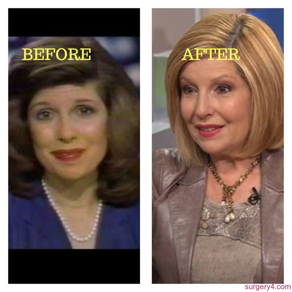 Sandie Rinaldo Plastic Surgery Photos [Before & After] ⋆