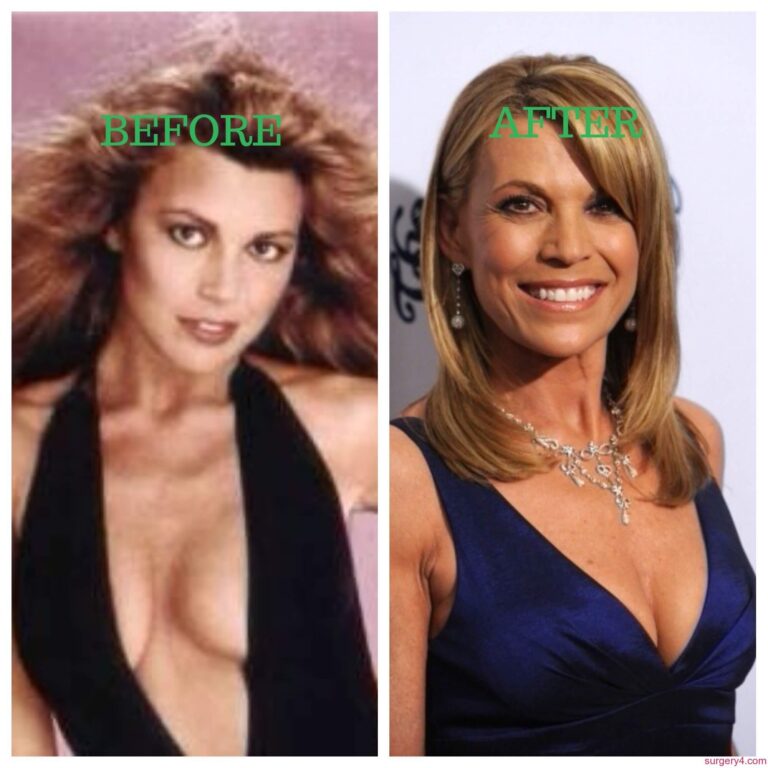 Vanna White Plastic Surgery Choosing The Appropriate Cosmetic Surgeon Is Never Ever Very Easy.