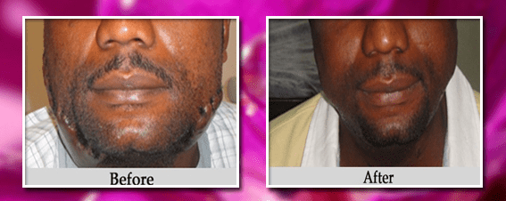 Smallpox Vaccine Pimples scar in Delhi, Smallpox Surgery Delhi