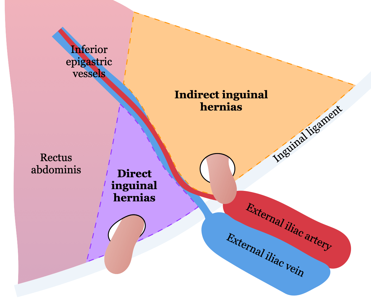 Inguinal Hernia Education | Education Center