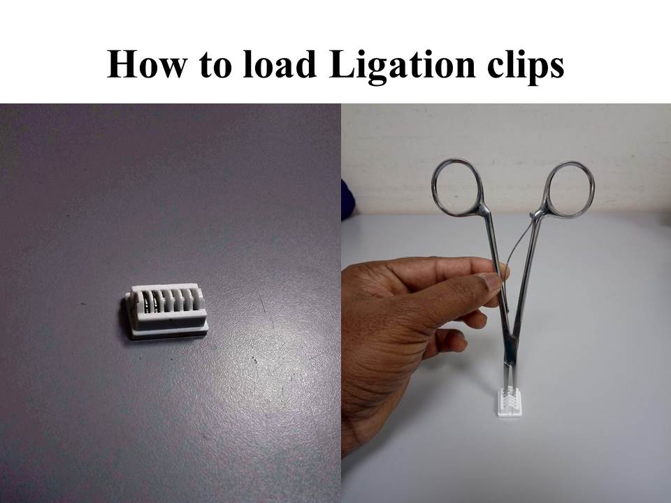 Ligaclips in controlling surgical haemostasis