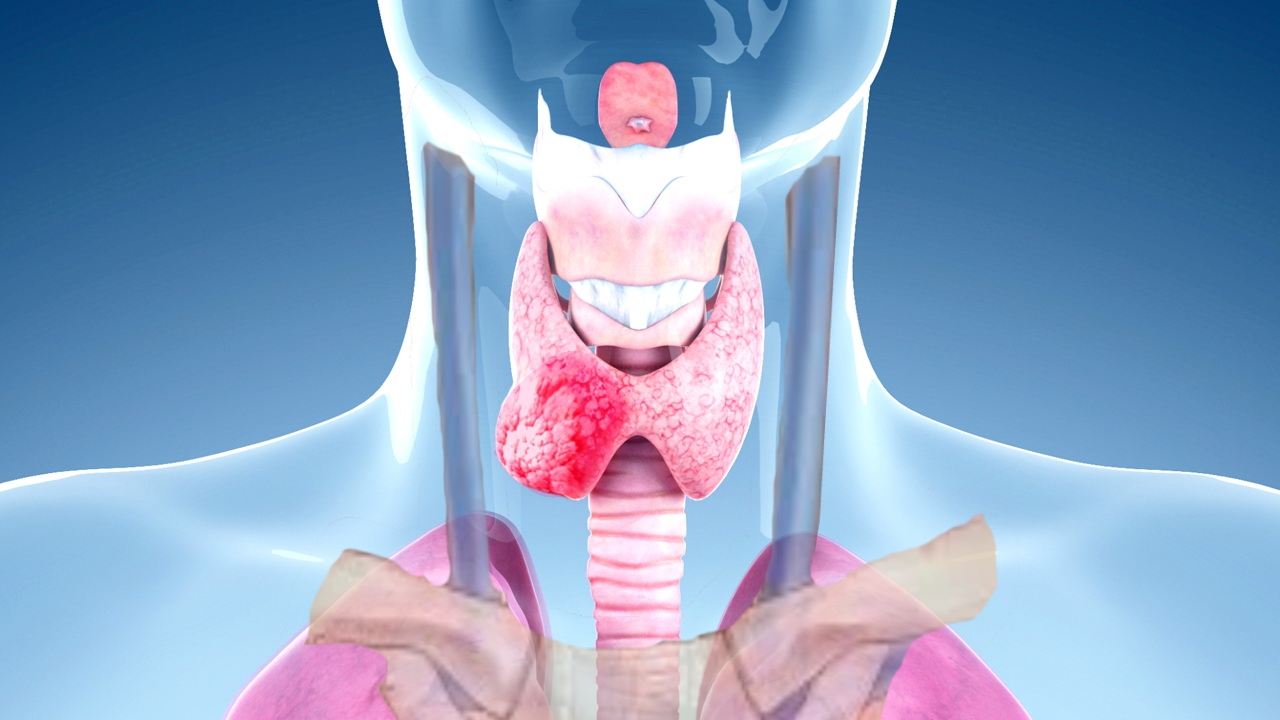 Thyroid Cancer SurgMedia