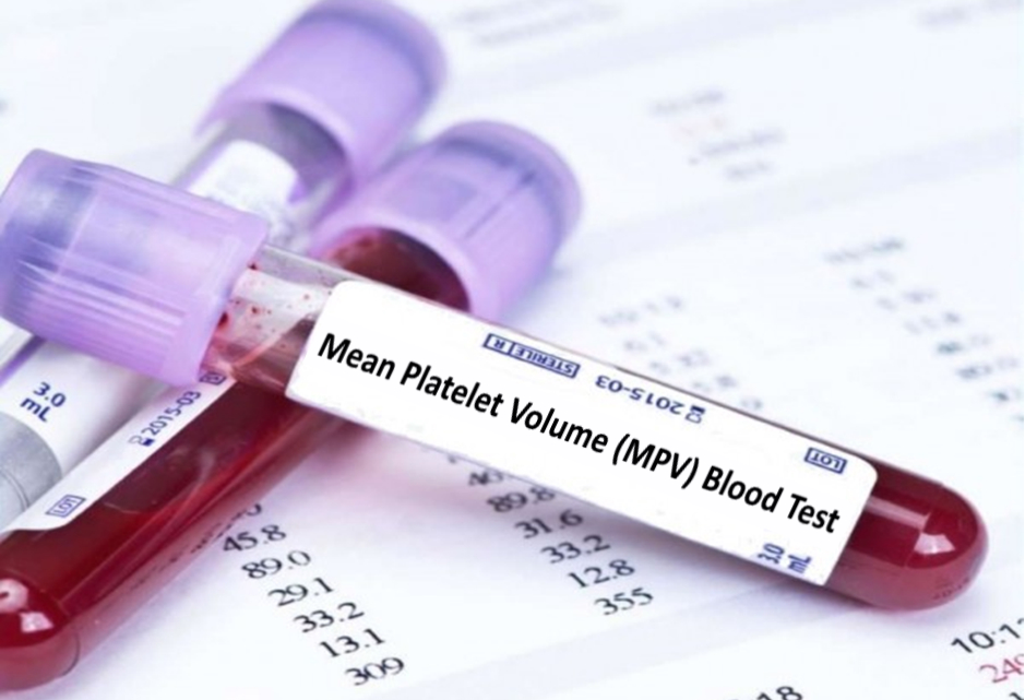 Understanding Mean Platelet Volume (MPV) Blood Test High MPV, Low MPV
