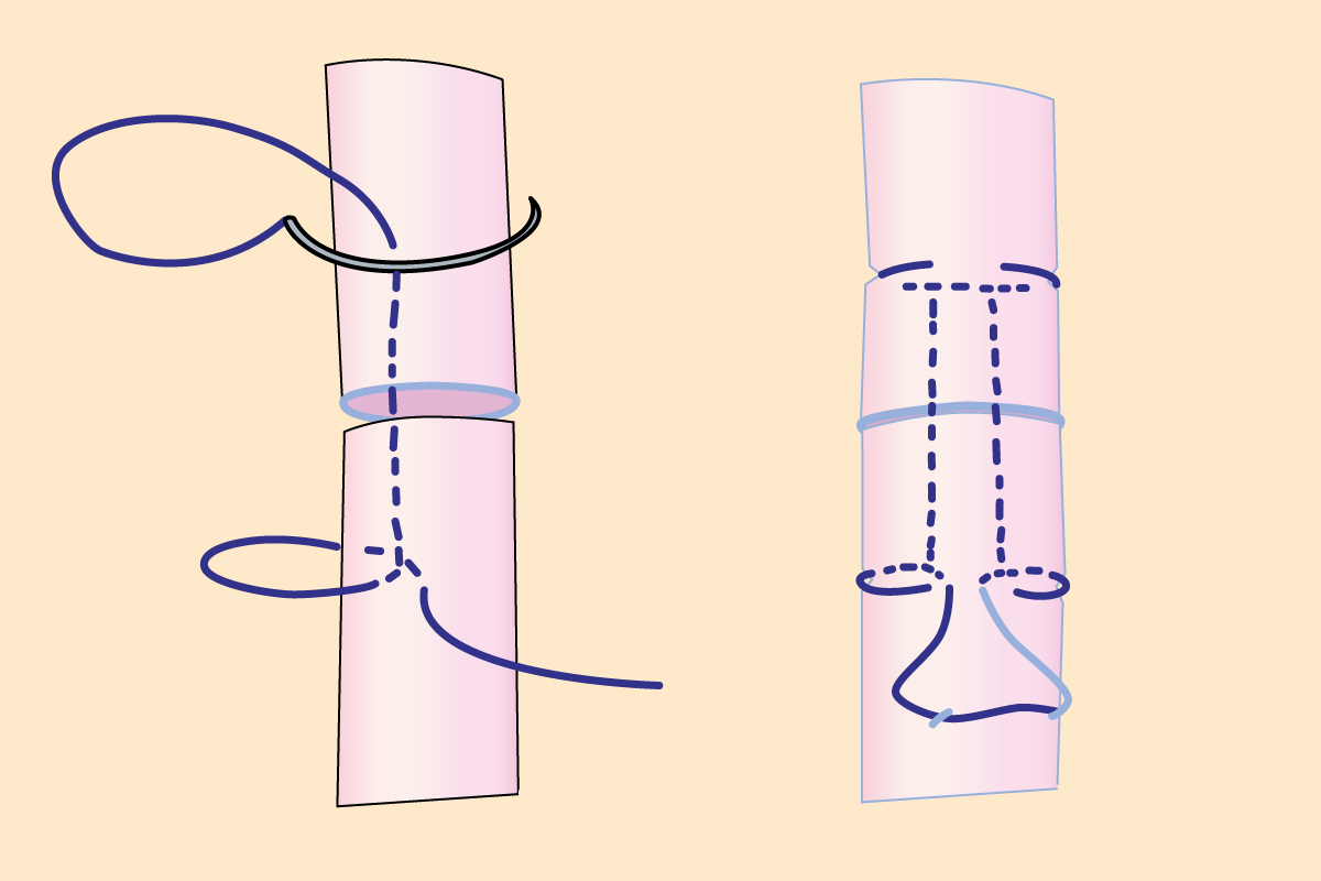 Common Suture Patterns SurgMedia