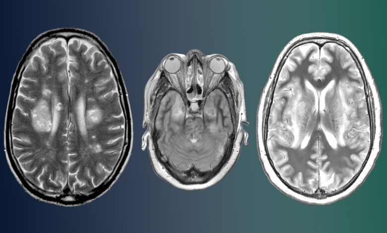COVID19 Survivors Literally Suffer From a Loss Gray Matter and Other