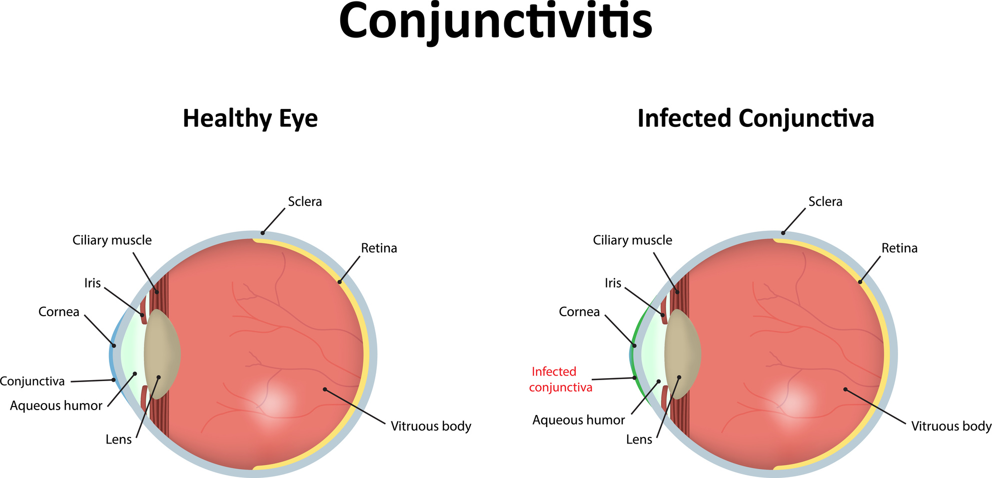 Conjuntivitis SKV Consultant