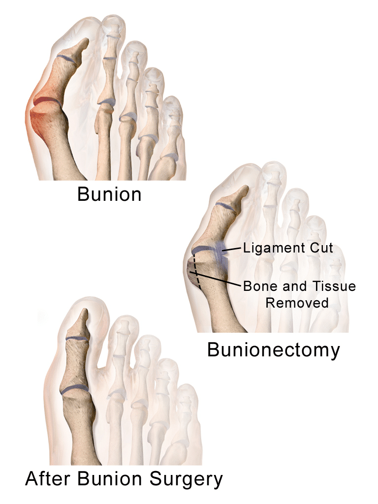 Bunionectomy Bunion Surgery Bunionectomy Recovery Cost Sutured