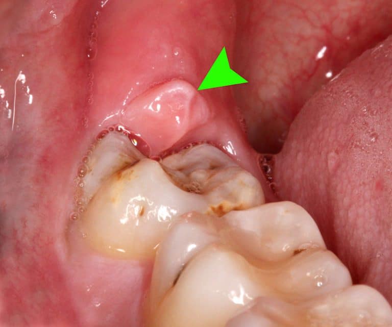 Operculectomy Procedure Cost Complications Sutured