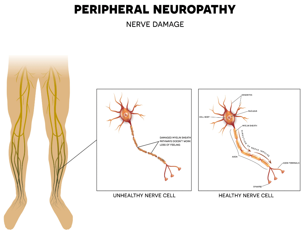 Small Fiber Neuropathy Causes and Treatment Suzy Cohen, RPh offers