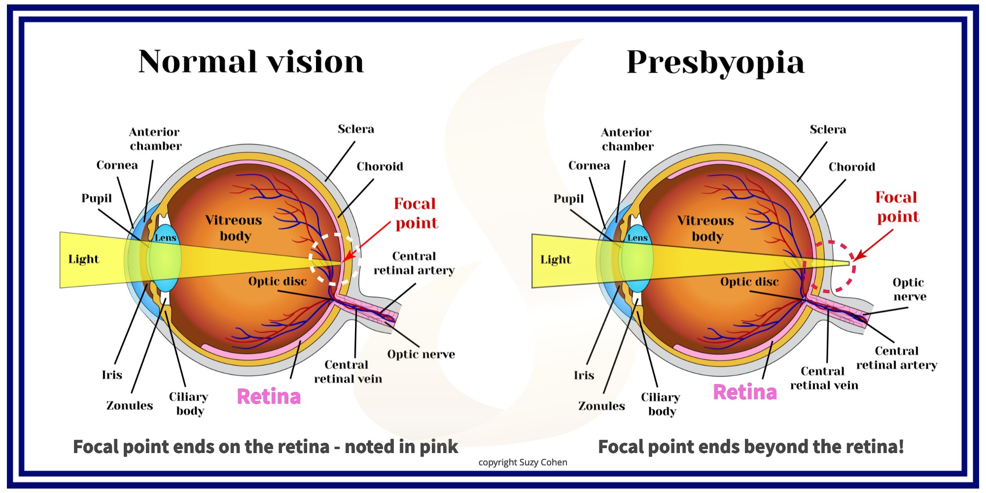 Eye Drops and 8 Natural Treatments for Blurry Vision Suzy Cohen, RPh