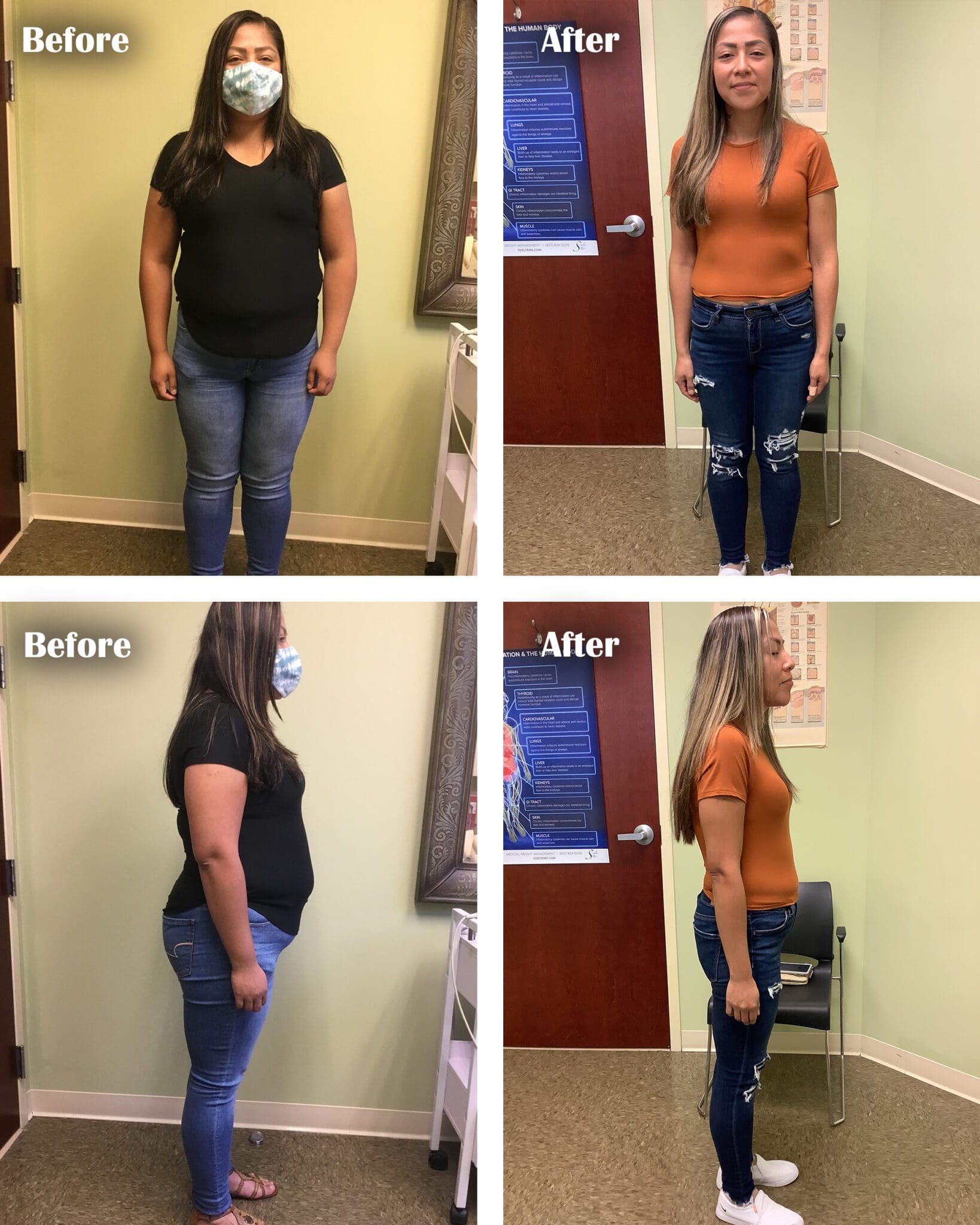 Semaglutide Weight Loss Orlando (407) 8045200