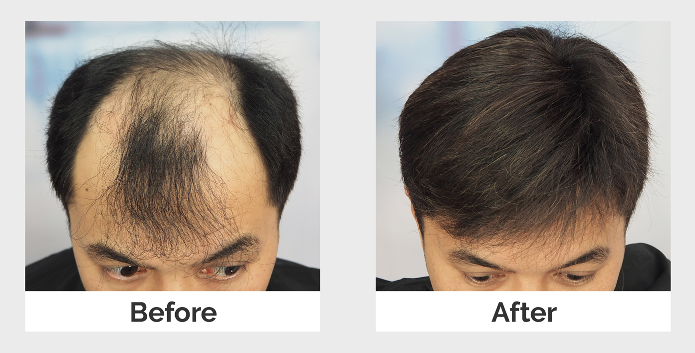 Longlasting and Manageable Hair Replacement Systems Svenson