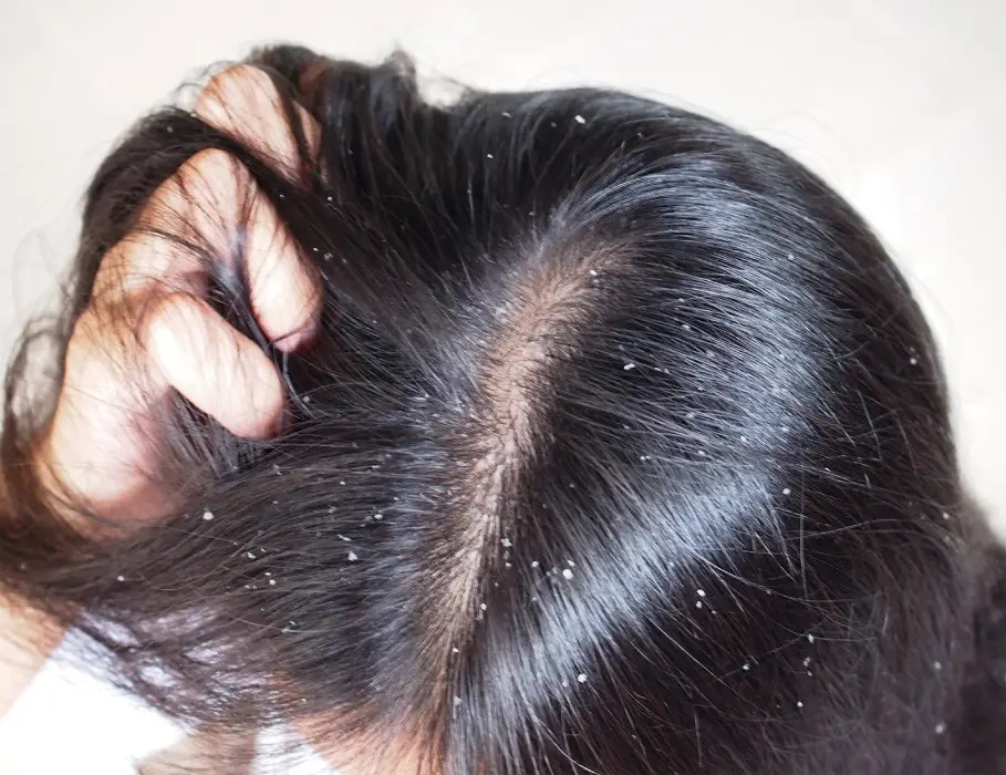 Hair Care 101 How to Tell if Your Scalp Is Unhealthy Marie France