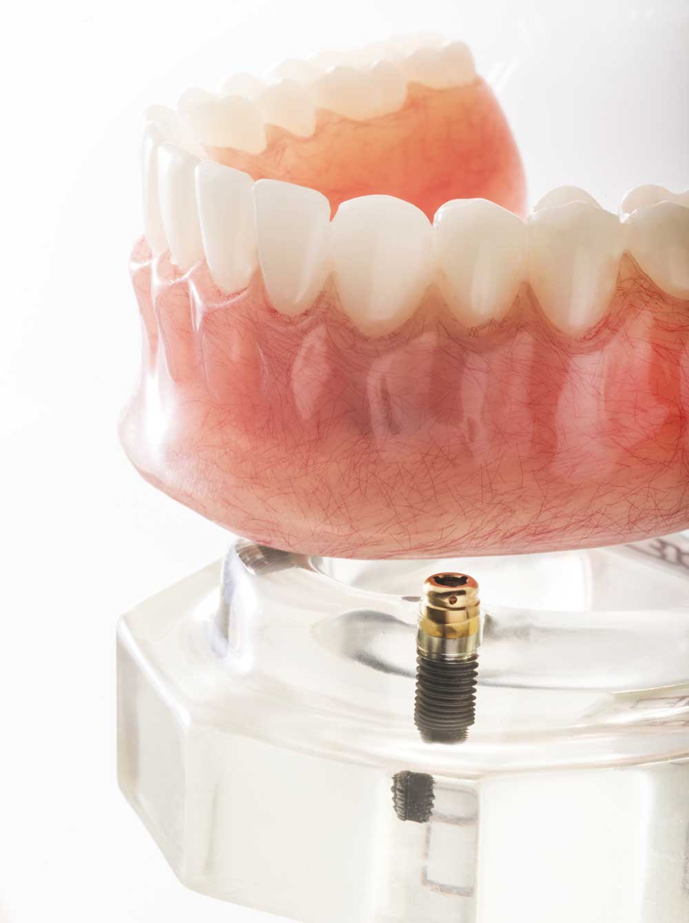 Hybrid Dentures in Port Orange, FL Sweet Comfort Dentures