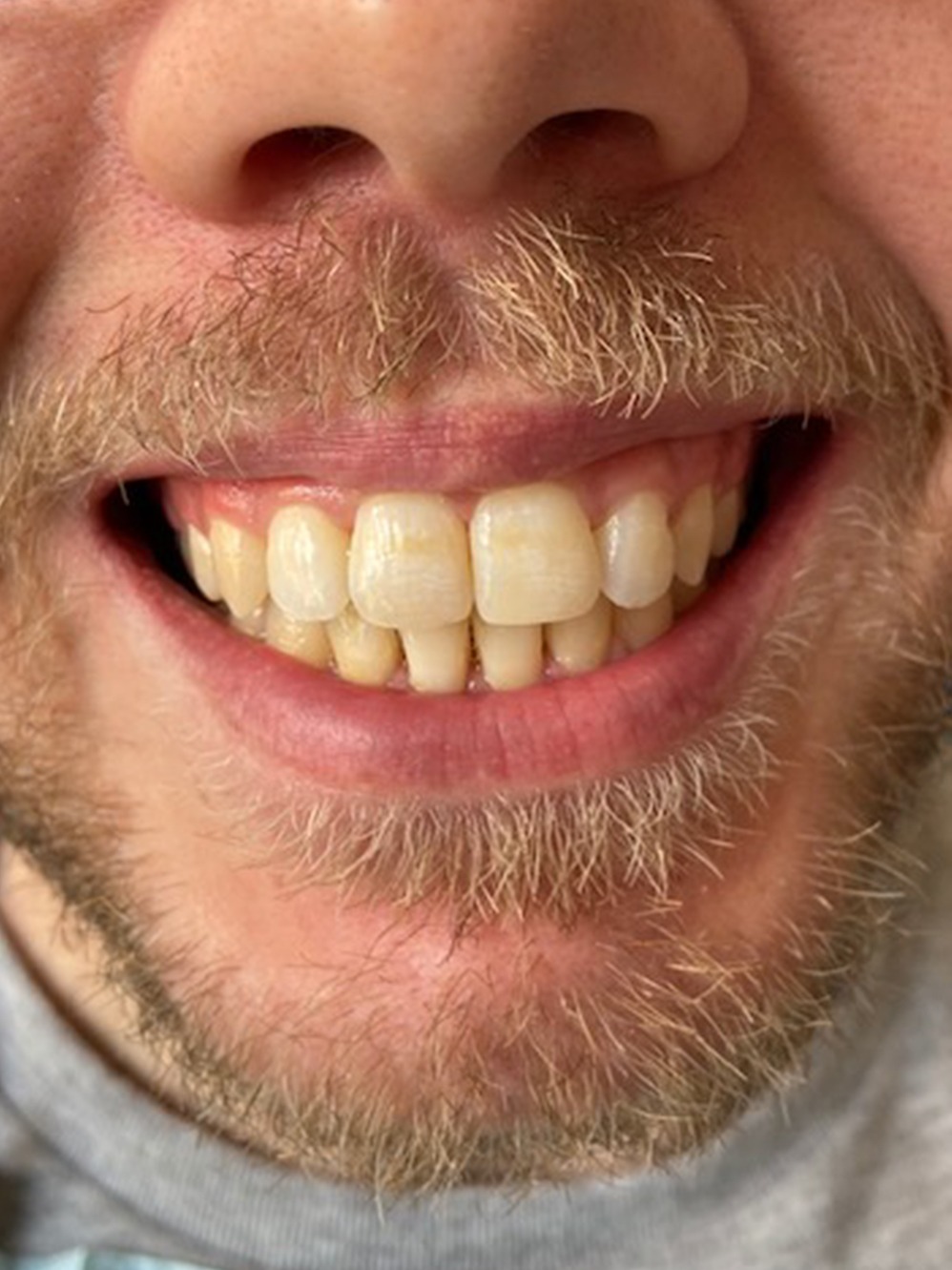 Cambridge Dentist Sweet Spot Dental Smile Gallery