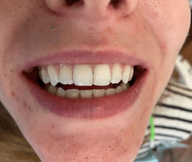 Cambridge Dentist Sweet Spot Dental Smile Gallery