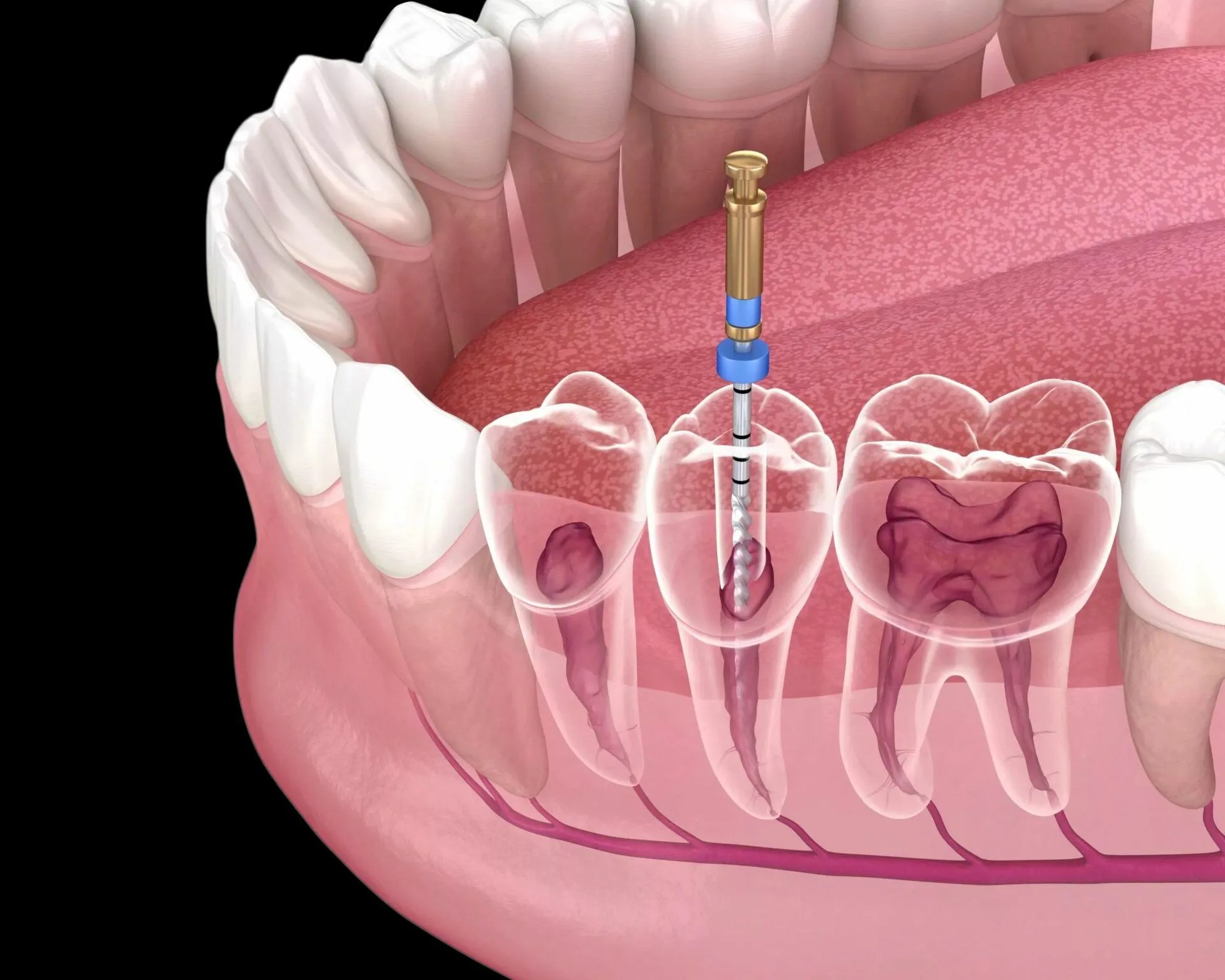 Fairhope AL Root Canal Dentist Sweet Water Dentistry