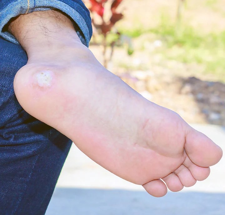 How to Get Rid of Calluses On Feet Swissklip