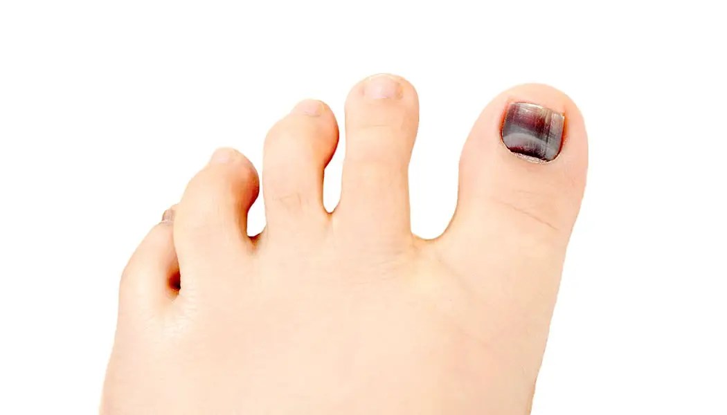 Why Is My Toenail Black? Top Causes & Fixes Swissklip