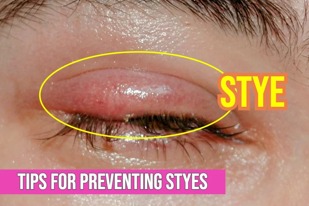 Swollen Eyelids Prevention The Role Of Good Hygiene