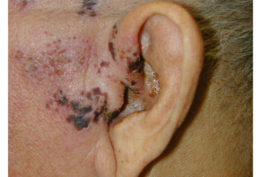 » Blog Archive » What Are Herpes